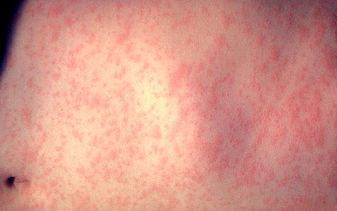 Top 5 Things You Should Know About Measles