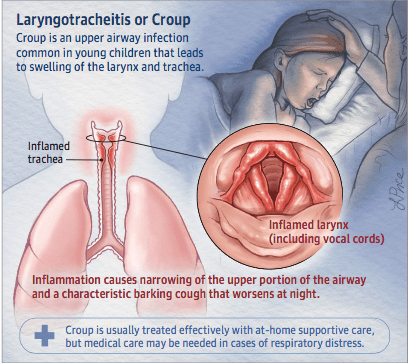 What is Croup?