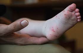 Five Things to Know About Hand-Foot-Mouth Disease